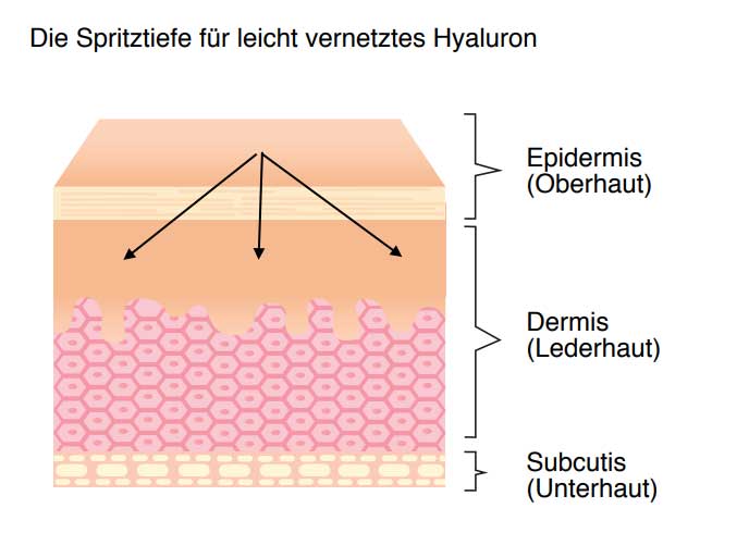 Leicht vernetzte Hyaluronsäure | Hyaluron, Hyaluronsäure, Lüneburg