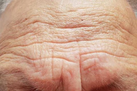 faltenbehandlung-die-h-ufigsten-hautfalten-arzt-dr-hartmann
